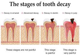 This is why removing as much plaque as possible each day is imperative to preventing cavities. Is It Possible To Reverse Tooth Decay Governor S Park Dental Group