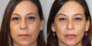 Best Eyelid Surgery in Dubai - EyeLift | Blepharoplasty Cost