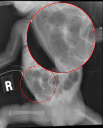 Necrotizing Enterocolitis Wikipedia