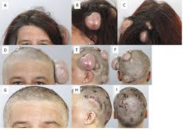 In order to remove a mass or cyst from the scalp or sometimes to reduce the tension of the skin edges, the surgeon may cut some of the hair follicles. Multiple Trichilemmal Cysts Of The Scalp Anticancer Research