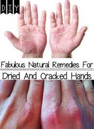 Two Natural Recipes That Will Help You Heal Cracked Skin On Your Hands Dry Hands Remedy Cracked Hands Dry Cracked Hands Remedy