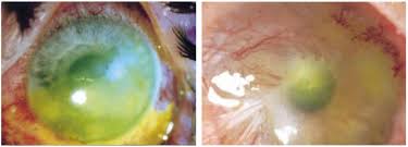 Image result for Eye Acidity Test