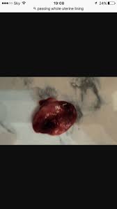 The inner lining of the uterus is called the endometrium. Expelled Something Weird During Miscarriage Graphic