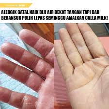 Dok knapa kulit saya menjadi hitam sebagian deket ibu jari setelah onani. Calla Imaan Kulit Alergik Gatal Sampai Naik Biji Biji Facebook