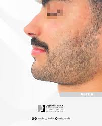 تصحيح جراحي لمراجع يعاني من تراجع الفك العلوي تم تقديم العلوي وتعديل الفك  السفلي لتناسق افضل بالتطابق 👍🏻 " اشكر المراجع لسماحه بعرض الحالة 💐 "  #جراحة_الفكين_التقويمية #جراحة_الفكين