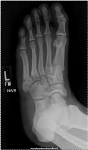 I recommend that you consult your surgeon about the specifics of your recovery as. A Traditional Jones Fracture Of Zone Ii Of The Prox Download Scientific Diagram