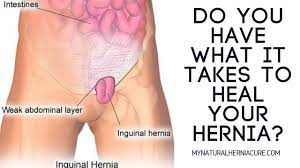 Do You Have What It Takes To Heal Your Hernia Naturally Without Surgery Youtube