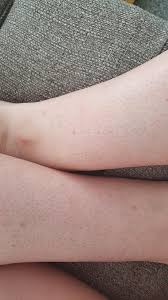 Learn more about the potential causes of hair loss on the legs, and how to treat them, here. Routine Help My Legs After Waxing Shaving Any Tips On How To Get Rid Of The Huge Holes Left Behind By My Incredibly Thick Hair Skincareaddiction