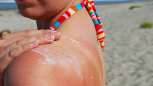 Image result for Sunburn