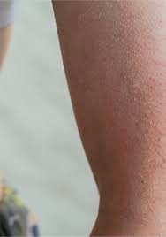 Image result for Keratosis pilaris