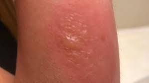 Brown recluse spider bites may not even be noticed at first as they are often painless. Woman Treated For Bubbling Infected Brown Recluse Spider Bite