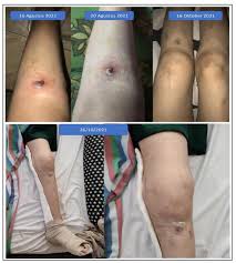 Image result for Osteomyelitis
