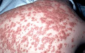25 years' experience with the biken oka strain varicella vaccine: Va Clinical Public Health Programs Hiv Aids Varicella Zoster Virus Vzv Images