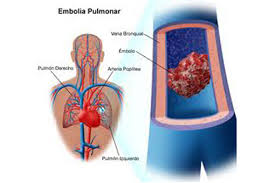 Chiamato condizione embolia polmonare in cui un coagulo di sangue entra l'arteria polmonare. Embolia Polmonare Mortalita Quasi Dimezzata Con La Trombolisi Ma