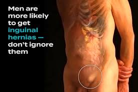 Image result for Inguinal hernia man