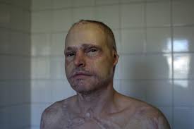 Photographing The Scars From Near Death Experiences