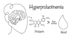 Image result for Hyperprolactinemia