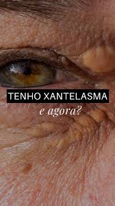 Image result for xantelasma