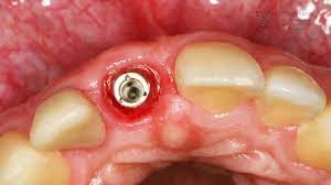 Maybe you would like to learn more about one of these? Find Out How Dental Implants Work Youtube