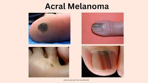 Image result for Acral lentiginous melanoma nail