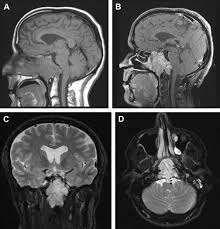 Image result for Chondrosarcoma