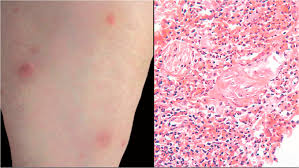 Image result for Panniculitis