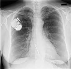 We would like to show you a description here but the site won't allow us. Abstract 193 52 Jahrige Patientin Mit Ratchet Syndrom Nach Reimplantation Eines Implantierbaren Kardioverter Defibrillators