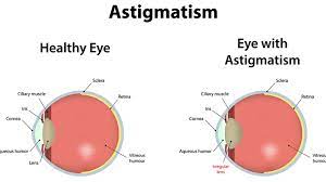 Astigmatism aberrations are similar to comatic aberrations, however these artifacts are not as sensitive to aperture size and depend more strongly on the oblique angle of the light beam. Astigmatism Understanding The Basics Of A Common Eye Condition Irisvision