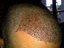 A hurricane and marketing woes couldn't keep these persistent franchisees down. Autotrapianto Poco Invasivo Anestesia Locale