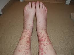You will find them all over your skin in various parts of your body but mostly in your arms and lower legs. Leukocytoclastic Vasculitis Rheumatology Advisor