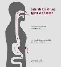 Enterale Ernahrung Aponova Gmbh