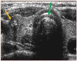 Ultrasound testing is often used as the first step in the standard cancer diagnostic process. Diagnosis Of Papillary Thyroid Cancer