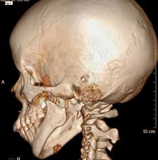 In addition, the pain may radiate down your leg or worsen with bending, twisting, lifting, standing or walking. Analysis For Different Functional Results Of Tmj Ankylosis Management By Comparing Ramus Condyle Unit Reconstruction Using Vertical Ramus Osteotomy And Interpositional Gap Arthroplasty Oral Surgery Oral Medicine Oral Pathology And Oral Radiology