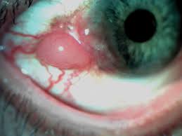 Image result for conjunctival melanoma