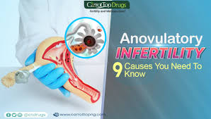 Image result for Anovulation