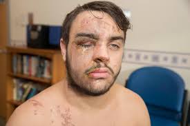 Second victim of Cumbernauld acid attack reveals he feared he would die of  heart failure