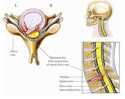 Ameliyatsiz Boyun Fitigi Tedavisi Fizyorem