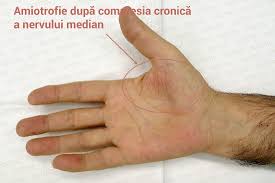 Potrivit mai multor studii, uleiul de in este un antiinflamator eficient care actioneaza cu precadere asupra extremitatilor corpului, ameliorand senzatia pe care o ai cand mainile iti amortesc. Furnicaturi Si Amorteli In Maini Si Degete Tratament Dr Vladislav Gyebnar