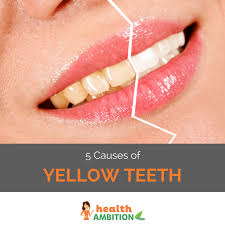 What Causes Yellow Teeth And What To Do About It Yellow Teeth Teeth Health Teeth