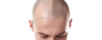 In fact, hair loss can be a devastating side effect of chemotherapy. Mesotherapy For Hair Loss Treatment And Side Effects