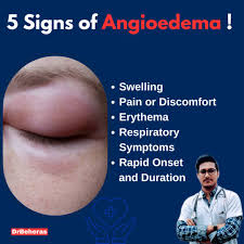 Image result for Angioedema