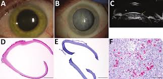 Ebola, also known as ebola virus disease (evd) or ebola hemorrhagic fever (ehf), is a viral hemorrhagic fever of humans and other primates caused by ebolaviruses. Figure Cataract Surgery In An Ebola Virus Disease Survivor With Prior Download Scientific Diagram