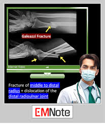 Image result for Galeazzi Sign