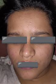 What should I do? 6+years with acne. I'd like to hear your suggestions and  opinions about what might be the problem.