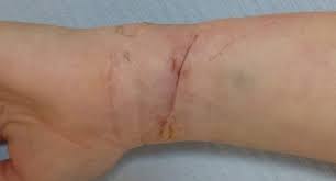 Surgical excision is best performed for a small tattoo on loose skin however always leaves a scar. Tattoo Removal Harley Plastic Surgery