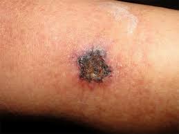Image result for Calciphylaxis