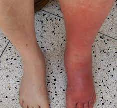 Check spelling or type a new query. Diabetic Foot Ulcers Classification Systems