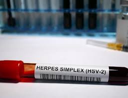 Image result for Herpes Simplex Virus Testing