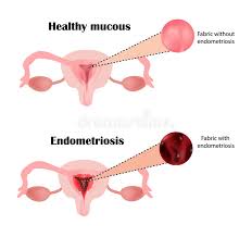 Meanings of endometriosis in german english dictionary : Bereiche In Denen Endometriumgewebe Erscheinen Kann Endometriosis Endometriosis Im Korper Die Struktur Der Lungen Vektor Abbildung Illustration Von Diagnose Biologie 78931085