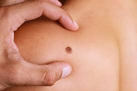 Skin cancer most often develops on areas of your body that get the greatest exposure to the sun's ultraviolet (uv) rays. You Have Skin Cancer Now What Lifespan